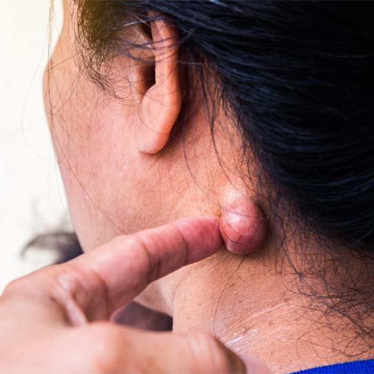 know-more-about-Sebaceous Cyst-treatment-in-Patna